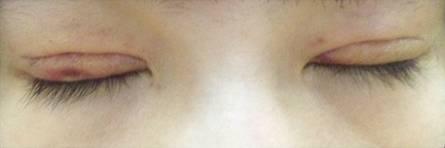 韓式三點(diǎn)雙眼皮是永久嗎？三點(diǎn)雙眼皮能保持多久？