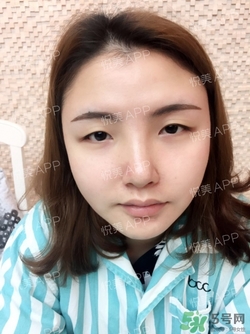 定點雙眼皮恢復過程圖_定點雙眼皮要多久恢復 定點雙眼皮恢復過程圖_定點雙眼皮要多久恢復