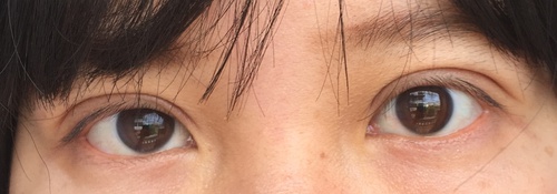 定點(diǎn)雙眼皮恢復(fù)過(guò)程圖_定點(diǎn)雙眼皮要多久恢復(fù) 定點(diǎn)雙眼皮恢復(fù)過(guò)程圖_定點(diǎn)雙眼皮要多久恢復(fù)