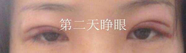三點雙眼皮恢復(fù)過程圖_韓式三點雙眼皮多久恢復(fù)自然