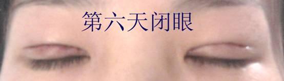 三點雙眼皮恢復(fù)過程圖_韓式三點雙眼皮多久恢復(fù)自然