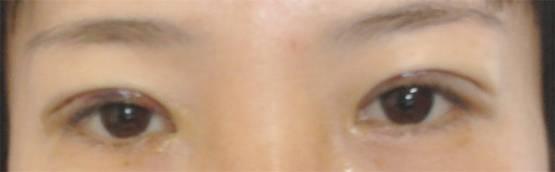 三點雙眼皮恢復(fù)過程圖_韓式三點雙眼皮多久恢復(fù)自然
