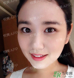 埋線雙眼皮的危害_埋線雙眼皮有風險后遺癥嗎 埋線雙眼皮的危害_埋線雙眼皮有風險后遺癥嗎