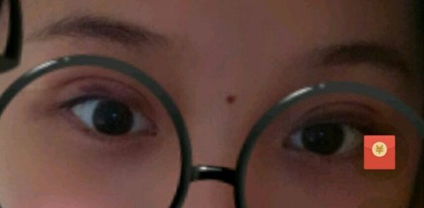 定點(diǎn)雙眼皮恢復(fù)過(guò)程圖_定點(diǎn)雙眼皮要多久恢復(fù) 定點(diǎn)雙眼皮恢復(fù)過(guò)程圖_定點(diǎn)雙眼皮要多久恢復(fù)