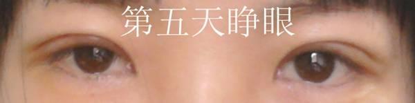 三點雙眼皮恢復(fù)過程圖_韓式三點雙眼皮多久恢復(fù)自然