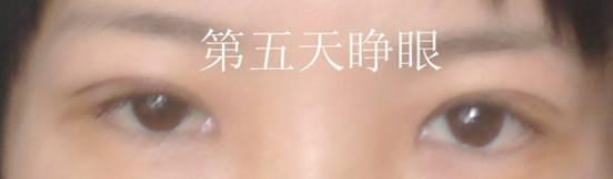 三點雙眼皮恢復(fù)過程圖_韓式三點雙眼皮多久恢復(fù)自然