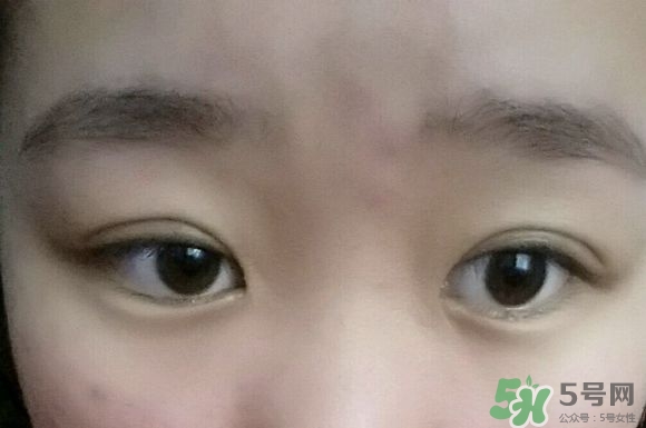 埋線雙眼皮需要拆線嗎？埋線雙眼皮怎么拆線