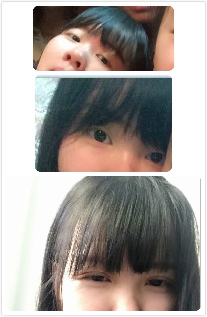 定點(diǎn)雙眼皮恢復(fù)過(guò)程圖_定點(diǎn)雙眼皮要多久恢復(fù) 定點(diǎn)雙眼皮恢復(fù)過(guò)程圖_定點(diǎn)雙眼皮要多久恢復(fù)