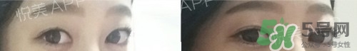 埋線雙眼皮多久恢復(fù)自然？埋線雙眼皮多久能恢復(fù)