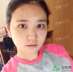 埋線雙眼皮的危害_埋線雙眼皮有風險后遺癥嗎 埋線雙眼皮的危害_埋線雙眼皮有風險后遺癥嗎