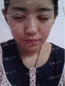 三點(diǎn)雙眼皮恢復(fù)過程圖_韓式三點(diǎn)雙眼皮多久恢復(fù)自然 三點(diǎn)雙眼皮恢復(fù)過程圖_韓式三點(diǎn)雙眼皮多久恢復(fù)自然