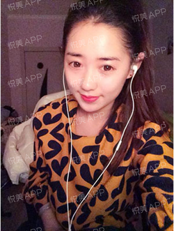 三點(diǎn)雙眼皮恢復(fù)過程圖_韓式三點(diǎn)雙眼皮多久恢復(fù)自然 三點(diǎn)雙眼皮恢復(fù)過程圖_韓式三點(diǎn)雙眼皮多久恢復(fù)自然