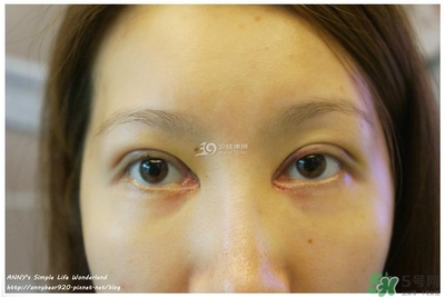 重瞼術(shù)多久能完全消腫 重瞼術(shù)恢復(fù)過程圖 重瞼術(shù)多久能完全消腫 重瞼術(shù)恢復(fù)過程圖