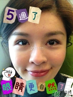 重瞼術(shù)是什么？重瞼術(shù)是永久的嗎？