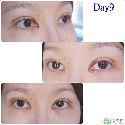 重瞼術(shù)多久能完全消腫 重瞼術(shù)恢復(fù)過程圖 重瞼術(shù)多久能完全消腫 重瞼術(shù)恢復(fù)過程圖