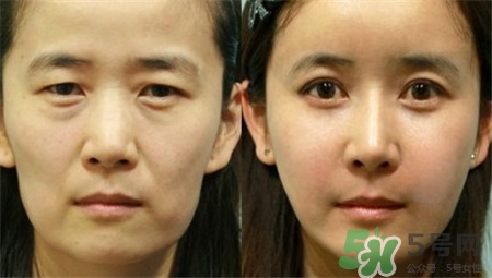 童顏針可以溶解嗎?童顏針的副作用 童顏針可以溶解嗎?童顏針的副作用