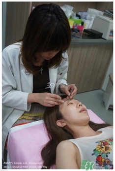 重瞼術(shù)多久能完全消腫 重瞼術(shù)恢復(fù)過程圖 重瞼術(shù)多久能完全消腫 重瞼術(shù)恢復(fù)過程圖