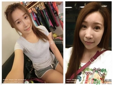 重瞼術(shù)多久能完全消腫 重瞼術(shù)恢復(fù)過程圖 重瞼術(shù)多久能完全消腫 重瞼術(shù)恢復(fù)過程圖