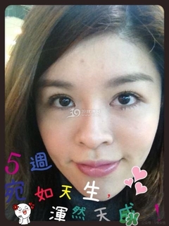 重瞼術(shù)是什么？重瞼術(shù)是永久的嗎？