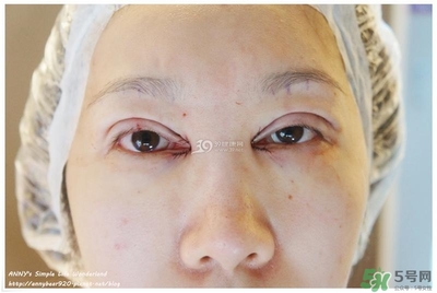 重瞼術(shù)多久能完全消腫 重瞼術(shù)恢復(fù)過程圖 重瞼術(shù)多久能完全消腫 重瞼術(shù)恢復(fù)過程圖