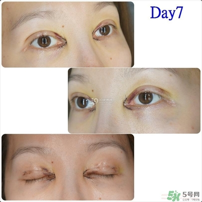 重瞼術(shù)多久能完全消腫 重瞼術(shù)恢復(fù)過程圖 重瞼術(shù)多久能完全消腫 重瞼術(shù)恢復(fù)過程圖