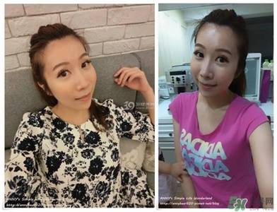 重瞼術(shù)多久能完全消腫 重瞼術(shù)恢復(fù)過程圖 重瞼術(shù)多久能完全消腫 重瞼術(shù)恢復(fù)過程圖