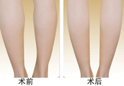 小腿吸脂多久見效？小腿吸脂后多久能看見效果？