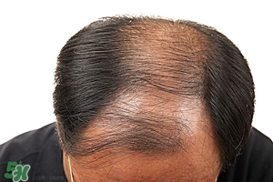 溢脂性脫發(fā)怎么治療?溢脂性脫發(fā)是什么原因 溢脂性脫發(fā)怎么治療?溢脂性脫發(fā)是什么原因