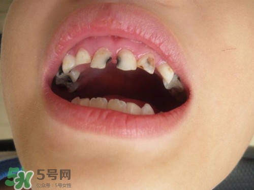 小孩換牙半年還沒長出來是怎么回事?小孩換牙注意事項 小孩換牙半年還沒長出來是怎么回事?小孩換牙注意事項