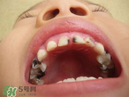 小孩換牙半年還沒長出來是怎么回事?小孩換牙注意事項 小孩換牙半年還沒長出來是怎么回事?小孩換牙注意事項