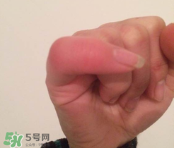 小拇指凍腫了怎么辦？為什么小拇指容易凍？