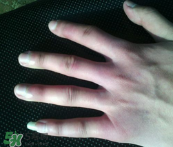 小拇指凍腫了怎么辦？為什么小拇指容易凍？