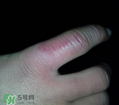 小拇指凍腫了怎么辦？為什么小拇指容易凍？