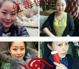 美國(guó)紅毒溶脂怎么樣？美國(guó)紅毒溶脂有用嗎？