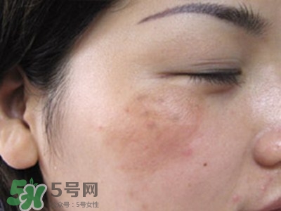 藏紅花能去黃褐斑嗎?怎么去黃褐斑最有效 藏紅花能去黃褐斑嗎?怎么去黃褐斑最有效