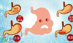 神經(jīng)性胃痙攣是什么？神經(jīng)性胃痙攣是什么原因？