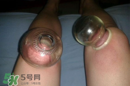 拔罐瘦腿真的有效嗎？腿部拔火罐減肥效果好嗎？