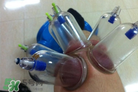 小腿能拔罐嗎？在小腿上拔火罐有什么作用？