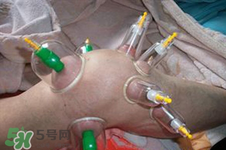 小腿能拔罐嗎？在小腿上拔火罐有什么作用？