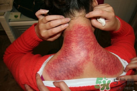 刮痧可以治頸椎病嗎？刮痧能治療頸椎病嗎？