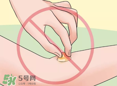 水泡怎么處理？水泡要不要刺破？