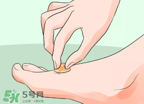 水泡怎么處理？水泡要不要刺破？