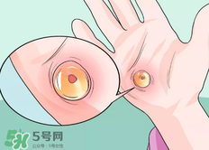 水泡怎么處理？水泡要不要刺破？