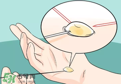 水泡怎么處理？水泡要不要刺破？