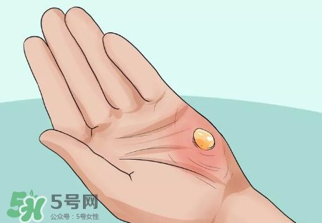 水泡怎么處理？水泡要不要刺破？