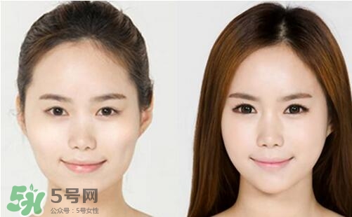 瘦臉針分為幾種類型？瘦臉針有哪幾個牌子？