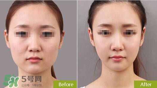 瘦臉針分為幾種類型？瘦臉針有哪幾個牌子？