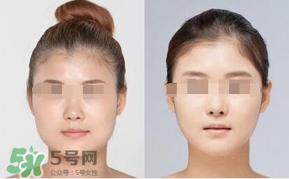 瘦臉針分為幾種類型？瘦臉針有哪幾個牌子？