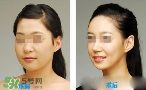 瘦臉針分為幾種類型？瘦臉針有哪幾個牌子？