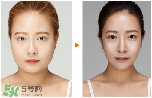 瘦臉針分為幾種類型？瘦臉針有哪幾個牌子？